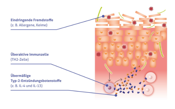Eine Grafik zeigt wie Keime sich auf verschiedenen Hautschichten auswirken.