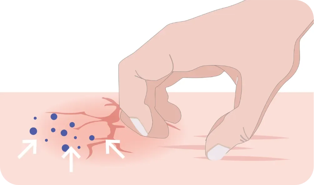 Darstellung des Juck-Kratz-Kreislauf bei Neurodermitis