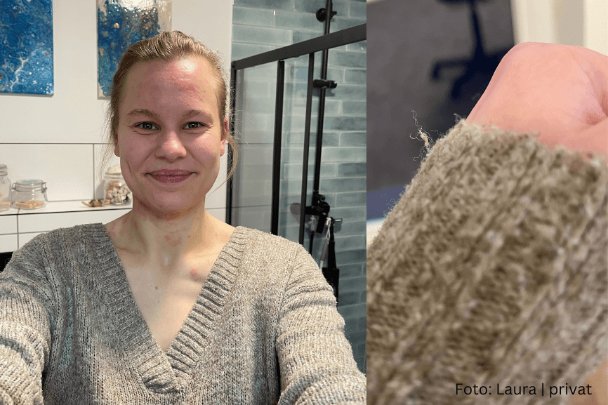 Laura trägt ihren beigen Pullover – Kleidung, die nicht mehr mit ihrer Neurodermitis vereinbar ist
