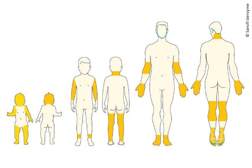 Die häufigsten Stellen bei Neurodermitis in jedem Alter